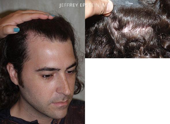 Hair Transplants for Men Before and after in Miami, FL, Paciente 40073