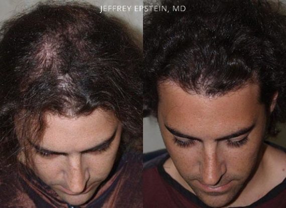 Trasplante de Pelo en Hombres Before and after in Miami, FL, Paciente 76271