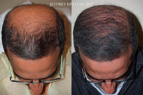 Hair Transplants for Men Before and after in Miami, FL, Paciente 40082