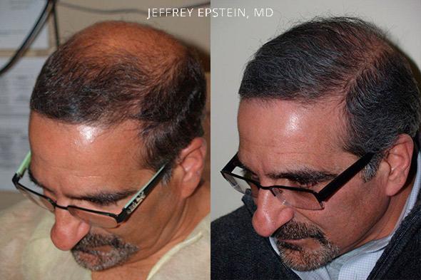 Hair Transplants for Men Before and after in Miami, FL, Paciente 40082