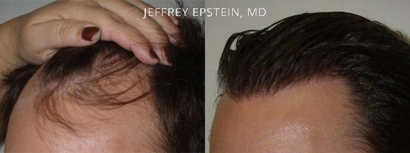 Hair Transplants for Men Before and after in Miami, FL, Paciente 40087