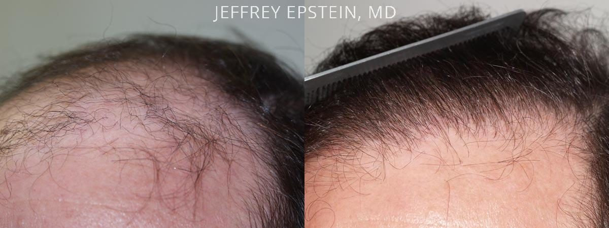 Hair Transplants for Men Before and after in Miami, FL, Paciente 40111