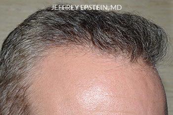 Hair Transplants for Men Before and after in Miami, FL, Paciente 40114