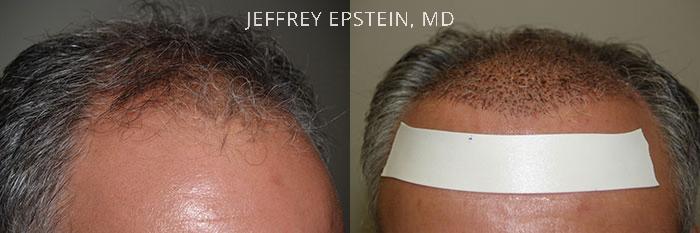 Hair Transplants for Men Before and after in Miami, FL, Paciente 40114