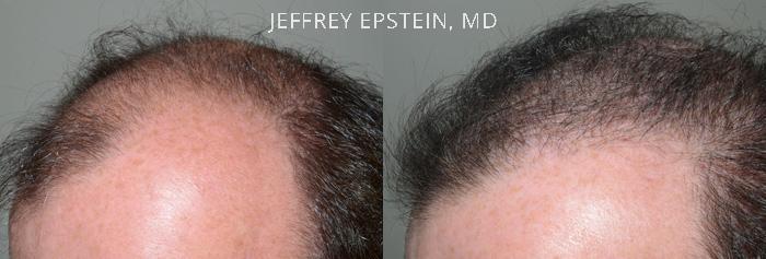 Hair Transplants for Men Before and after in Miami, FL, Paciente 40118