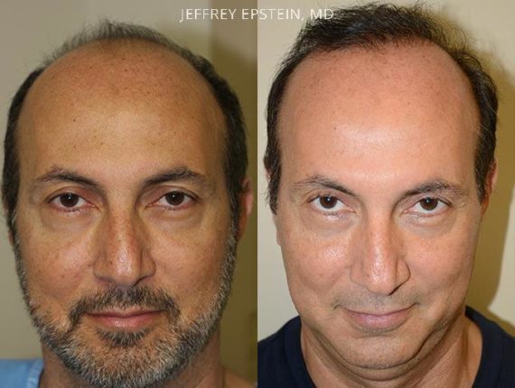 Trasplante de Pelo en Hombres Before and after in Miami, FL, Paciente 75997