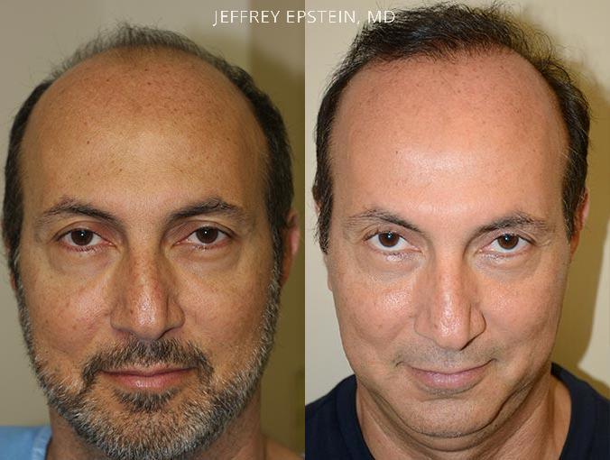 Trasplante de Pelo en Hombres Antes y después en Miami, FL, Paciente 75997