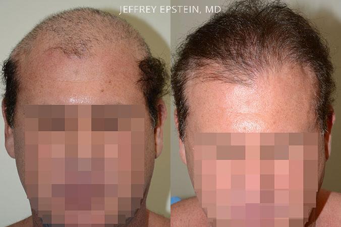 Trasplante de Pelo en Hombres Before and after in Miami, FL, Paciente 40134