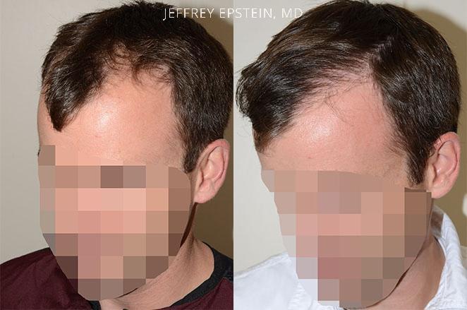 Hair Transplants for Men Before and after in Miami, FL, Paciente 40137