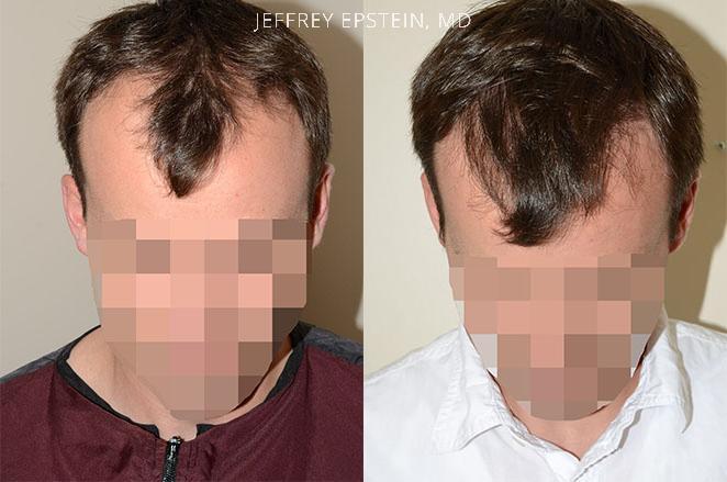 Hair Transplants for Men Before and after in Miami, FL, Paciente 40137