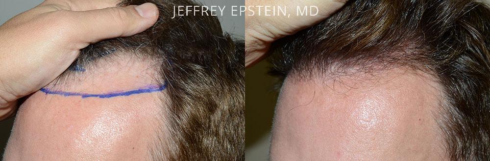 Hair Transplants for Men Before and after in Miami, FL, Paciente 40151