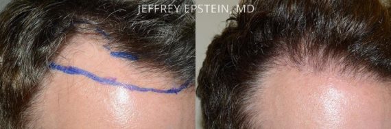 Hair Transplants for Men Before and after in Miami, FL, Paciente 40151