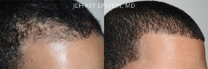 Hair Transplants for Men Before and after in Miami, FL, Paciente 40157