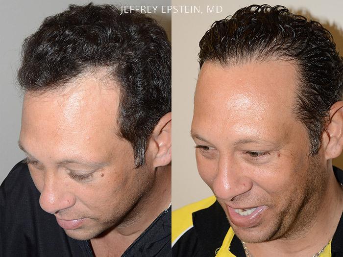 Hair Transplants for Men Before and after in Miami, FL, Paciente 40160