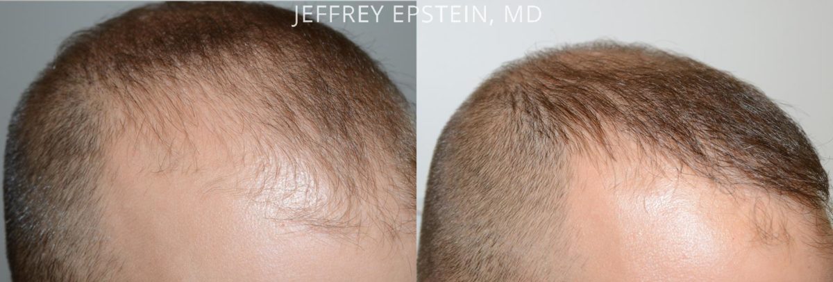 Hair Transplants for Men Before and after in Miami, FL, Paciente 40171