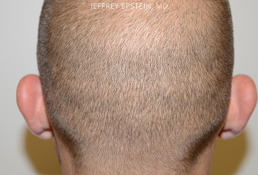 Hair Transplants for Men Before and after in Miami, FL, Paciente 40171