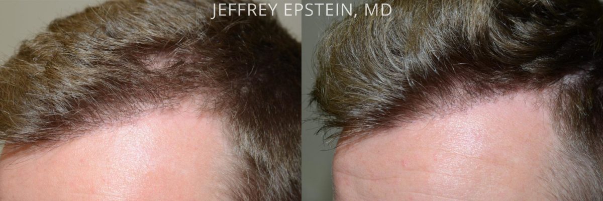 Hair Transplants for Men Before and after in Miami, FL, Paciente 40177