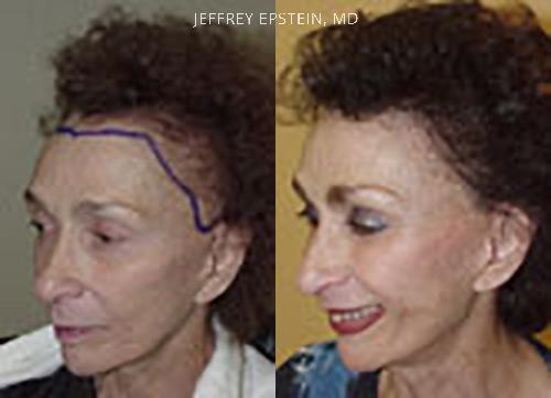 Reparación Cicatriz de Estiramiento Facial Before and after in Miami, FL, Paciente 93859