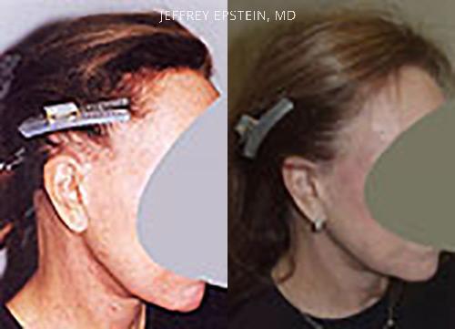 Reparación Cicatriz de Estiramiento Facial Before and after in Miami, FL, Paciente 93844