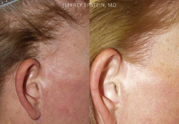 Reparación Cicatriz de Estiramiento Facial Before and after in Miami, FL, Paciente 93823