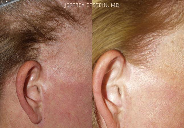 Repair Facelift Scarring Before and after in Miami, FL, Paciente 40202