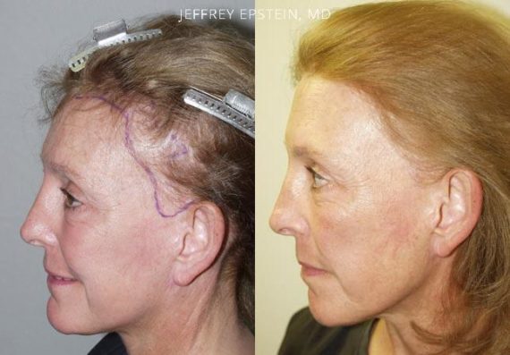 Repair Facelift Scarring Before and after in Miami, FL, Paciente 40202