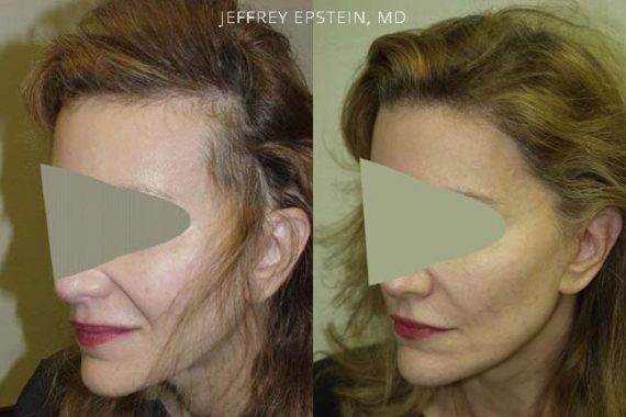 Reparación Cicatriz de Estiramiento Facial Before and after in Miami, FL, Paciente 93791