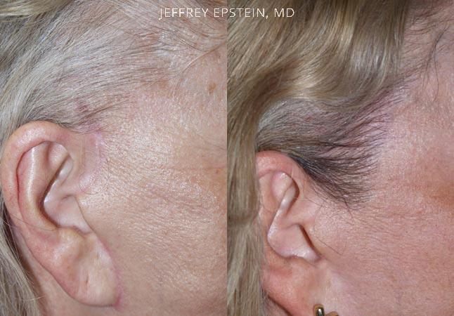 Repair Facelift Scarring Before and after in Miami, FL, Paciente 40215