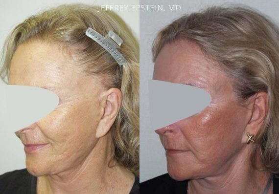 Reparación Cicatriz de Estiramiento Facial Before and after in Miami, FL, Paciente 93770