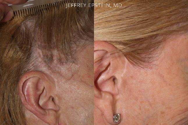 Reparación Cicatriz de Estiramiento Facial Antes y después en Miami, FL, Paciente 93749
