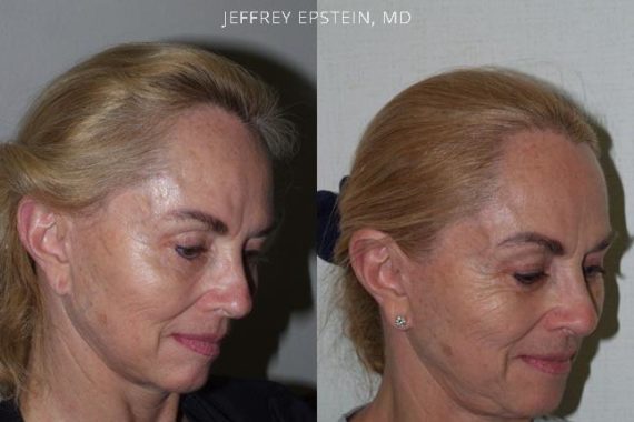 Reparación Cicatriz de Estiramiento Facial Before and after in Miami, FL, Paciente 93749