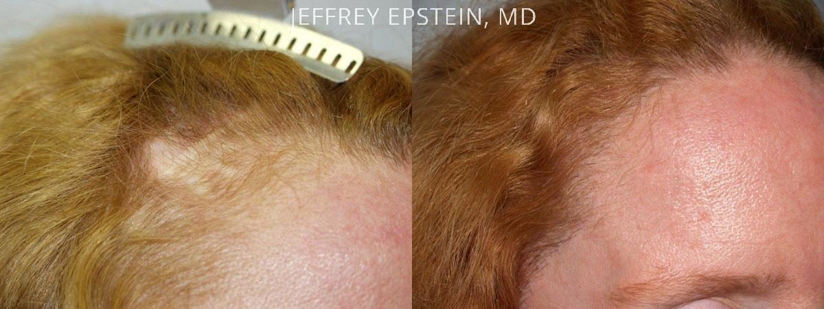 Repair Facelift Scarring Before and after in Miami, FL, Paciente 40225