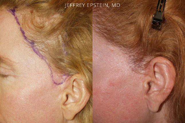Reparación Cicatriz de Estiramiento Facial Antes y después en Miami, FL, Paciente 93656