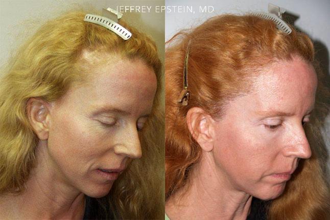 Repair Facelift Scarring Before and after in Miami, FL, Paciente 40225