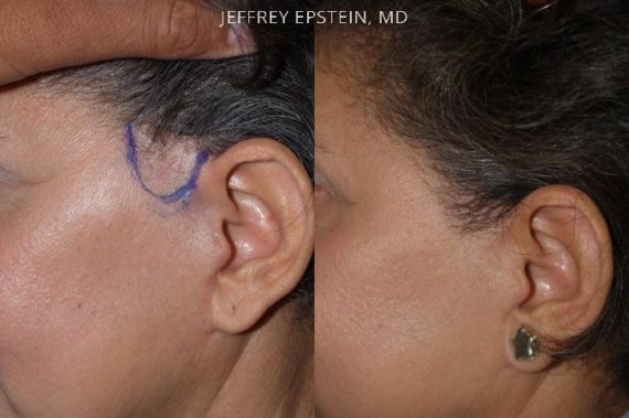 Reparación Cicatriz de Estiramiento Facial Before and after in Miami, FL, Paciente 93631