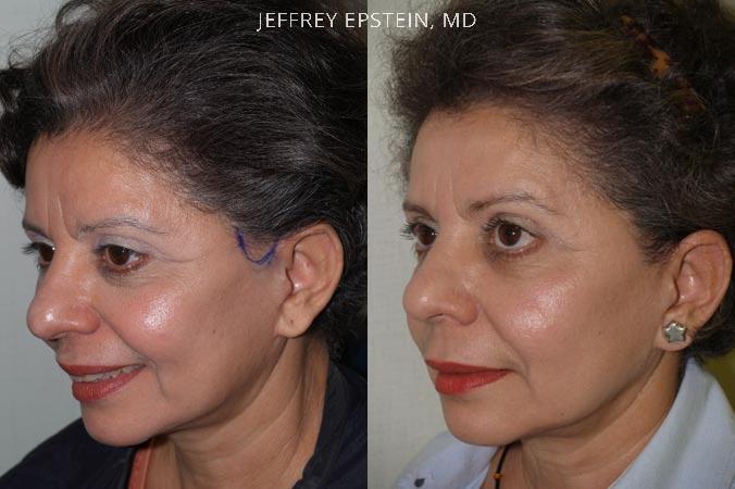 Repair Facelift Scarring Before and after in Miami, FL, Paciente 40240