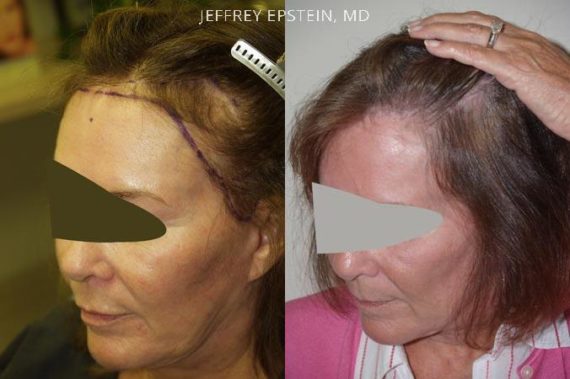 Reparación Cicatriz de Estiramiento Facial Before and after in Miami, FL, Paciente 93610