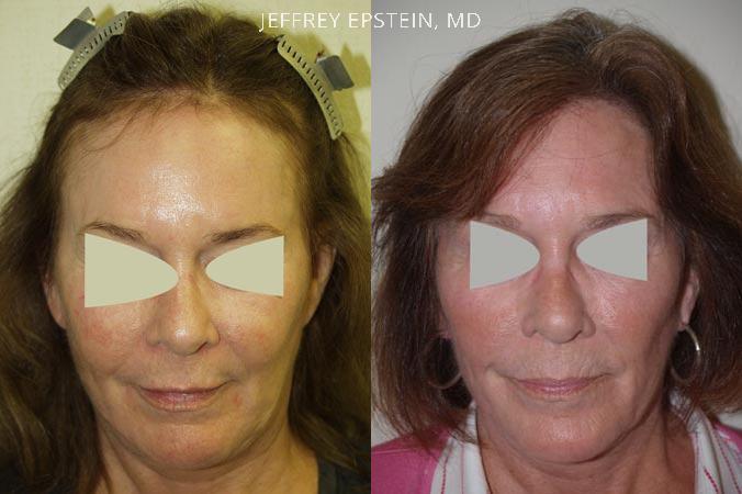 Repair Facelift Scarring Before and after in Miami, FL, Paciente 40245