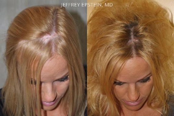 Reparación Cicatriz de Estiramiento Facial Before and after in Miami, FL, Paciente 93599