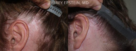 Reparación Cicatriz de Estiramiento Facial Before and after in Miami, FL, Paciente 93574