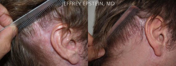 Reparación Cicatriz de Estiramiento Facial Before and after in Miami, FL, Paciente 93574