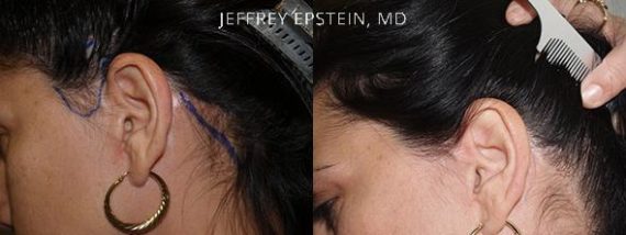 Repair Facelift Scarring Before and after in Miami, FL, Paciente 40258