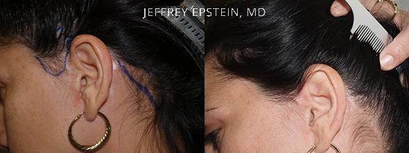 Reparación Cicatriz de Estiramiento Facial Antes y después en Miami, FL, Paciente 93549