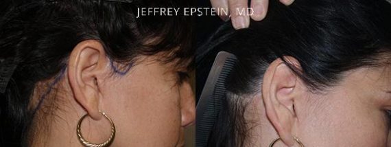 Reparación Cicatriz de Estiramiento Facial Before and after in Miami, FL, Paciente 93549