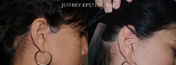 Repair Facelift Scarring Before and after in Miami, FL, Paciente 40258