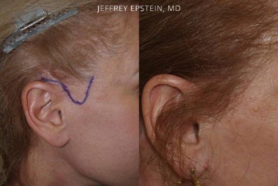 Reparación Cicatriz de Estiramiento Facial Before and after in Miami, FL, Paciente 93507