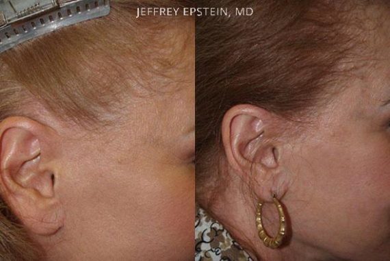 Reparación Cicatriz de Estiramiento Facial Before and after in Miami, FL, Paciente 93507