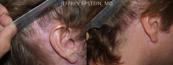 Reparación Cicatriz de Estiramiento Facial Before and after in Miami, FL, Paciente 93496