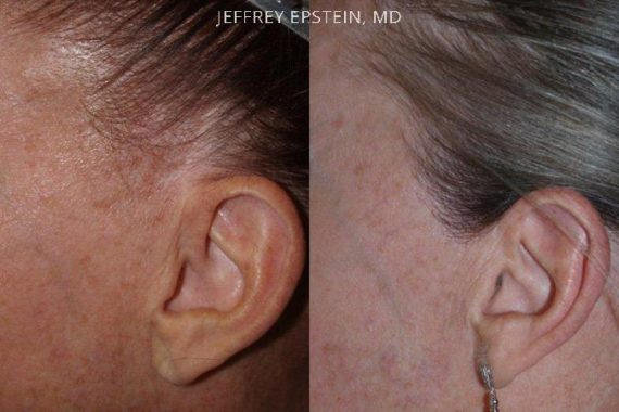 Reparación Cicatriz de Estiramiento Facial Before and after in Miami, FL, Paciente 93475
