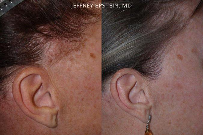 Repair Facelift Scarring Before and after in Miami, FL, Paciente 40274